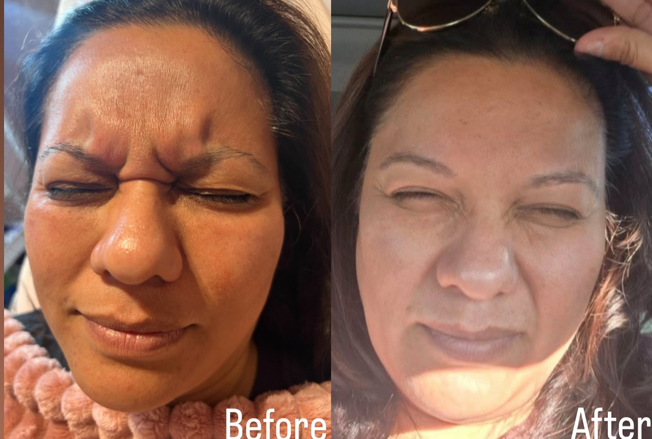Before and after Fine Line and Wrinkle Treatment result 1