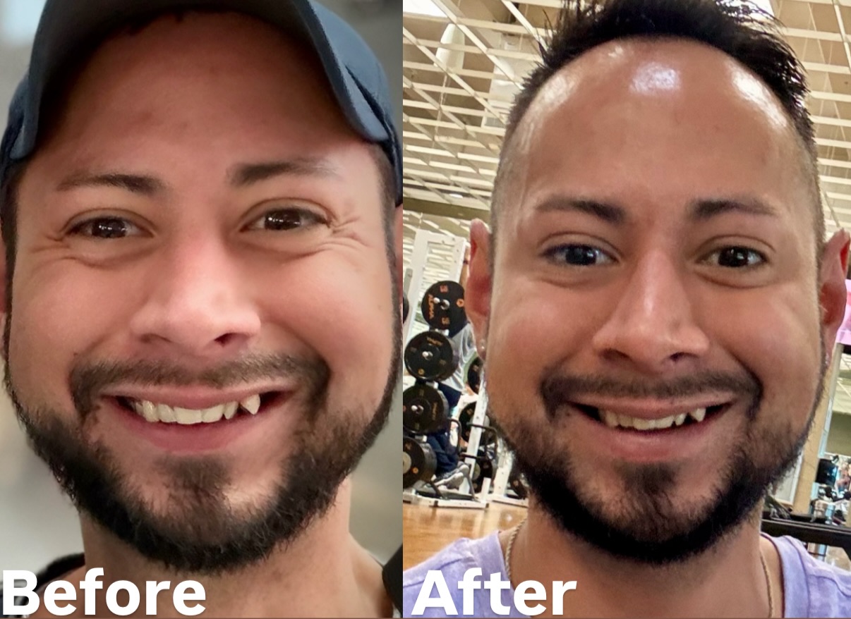 Before and after Fine Line and Wrinkle Treatment result 2