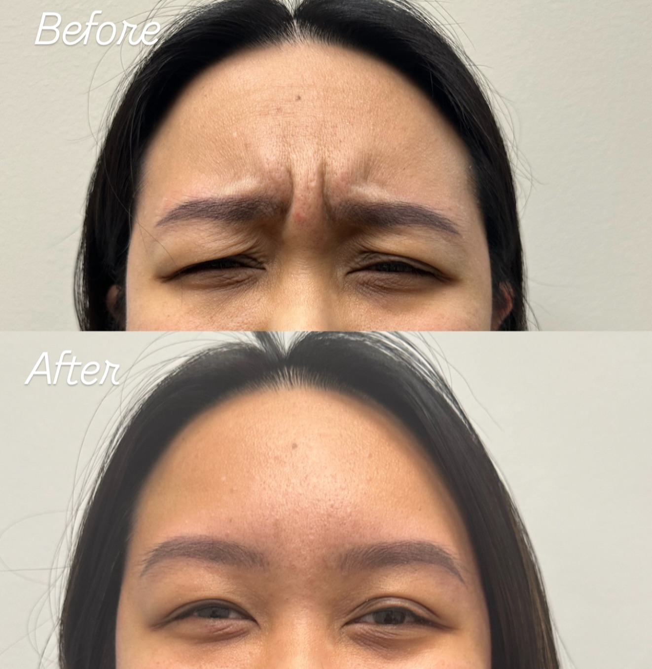 Before and after Fine Line and Wrinkle Treatment result 3