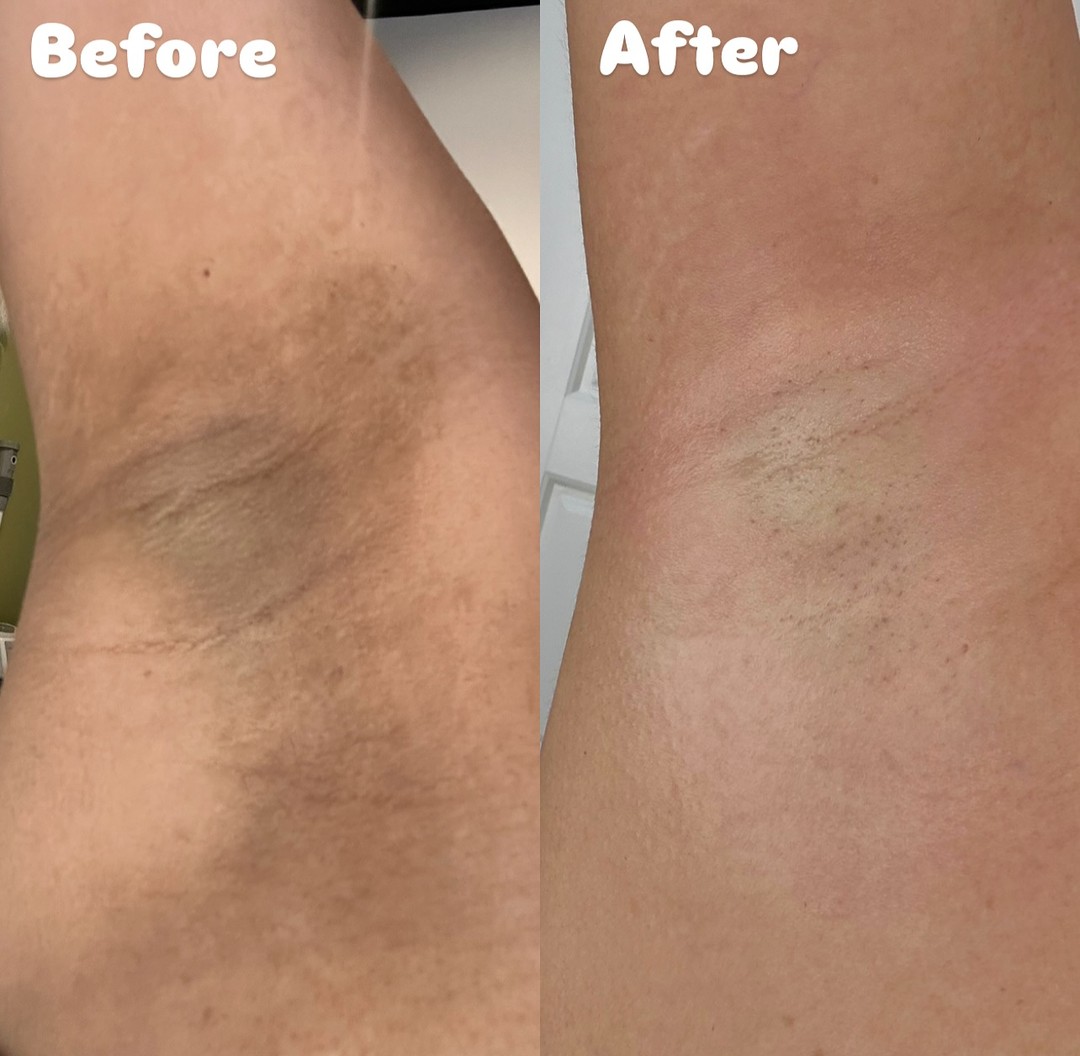 Before and after Chemical Peels result 1