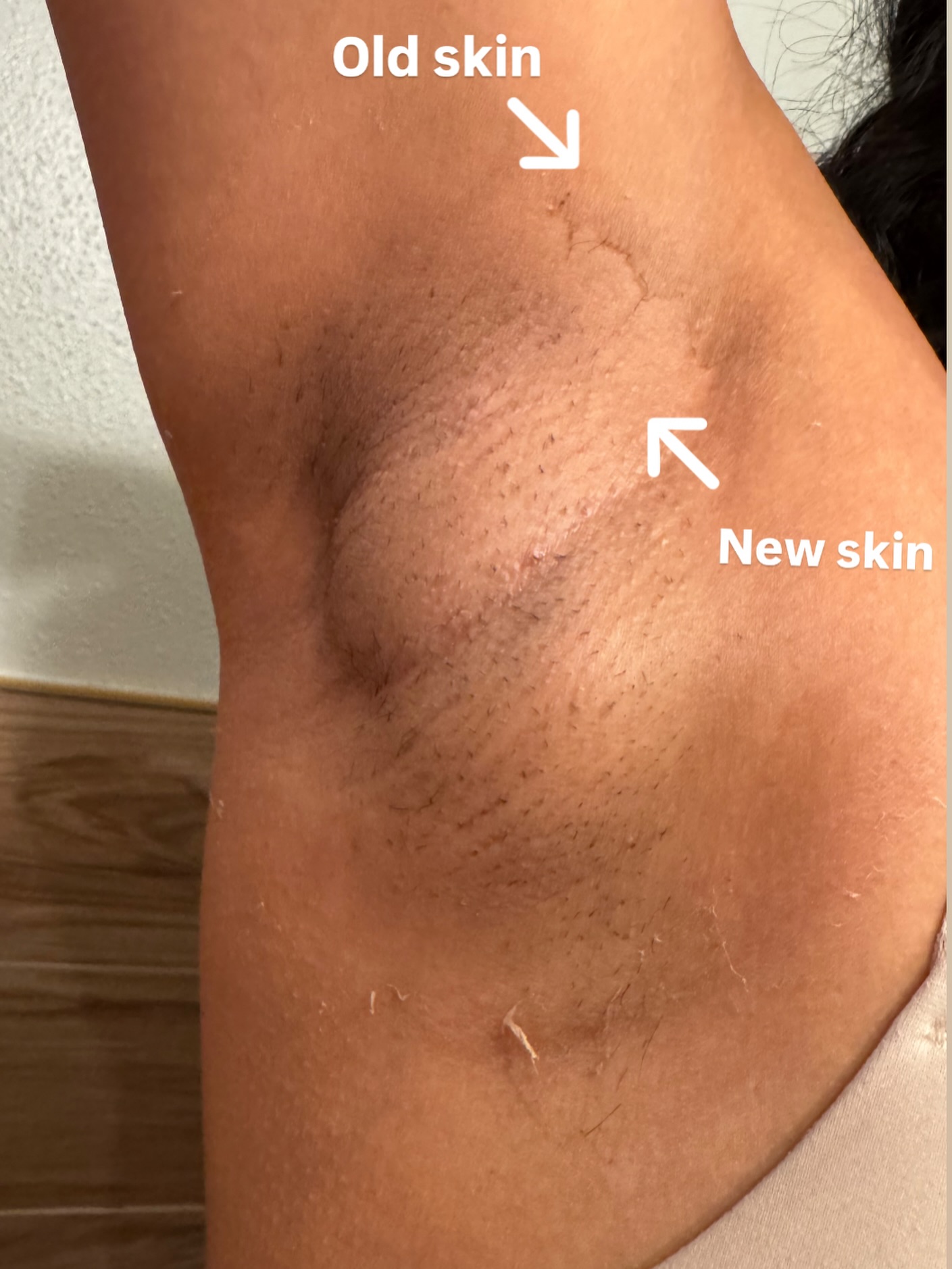 Before and after Chemical Peels result 2