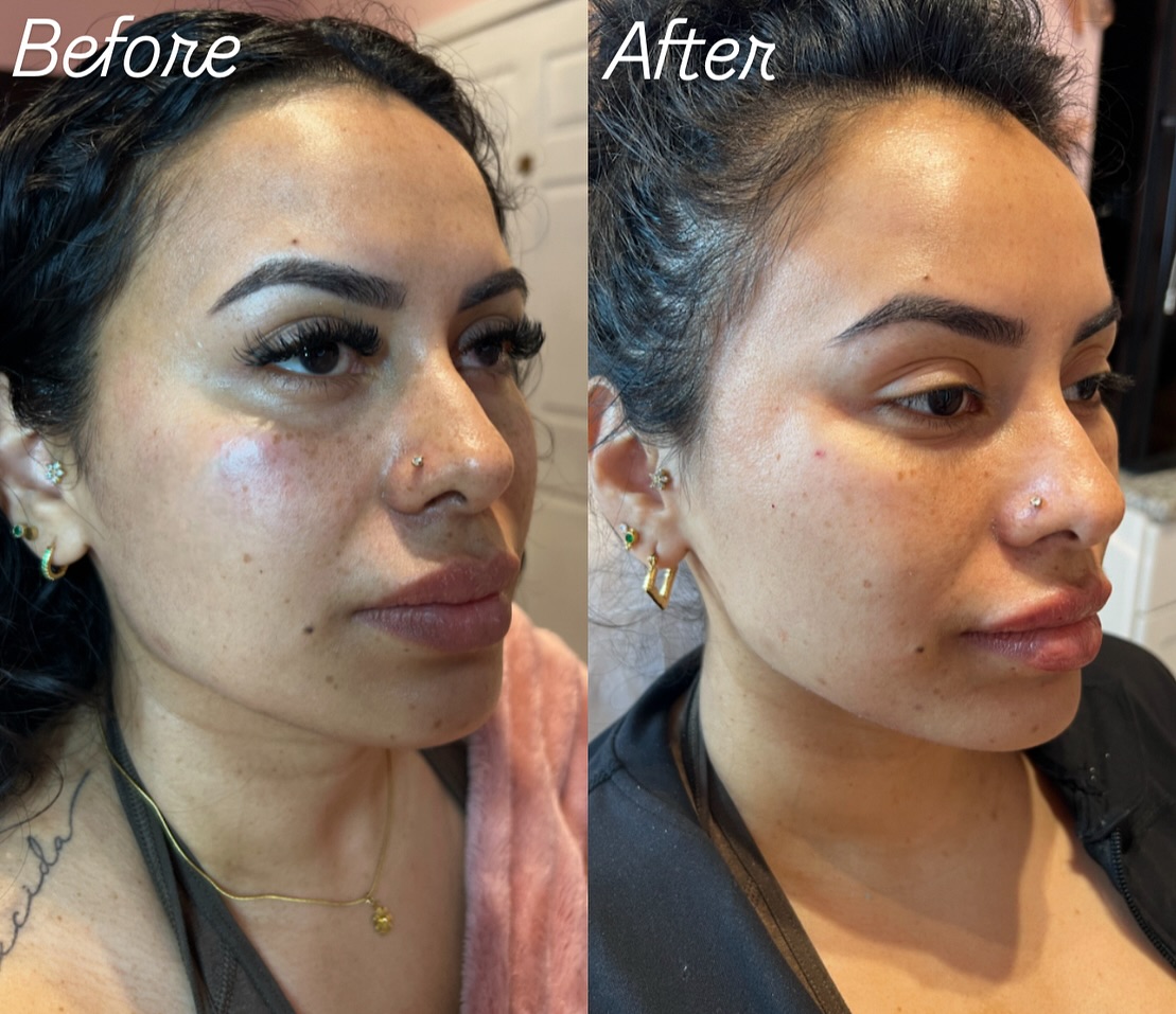 Before and after Dermal Fillers result 1