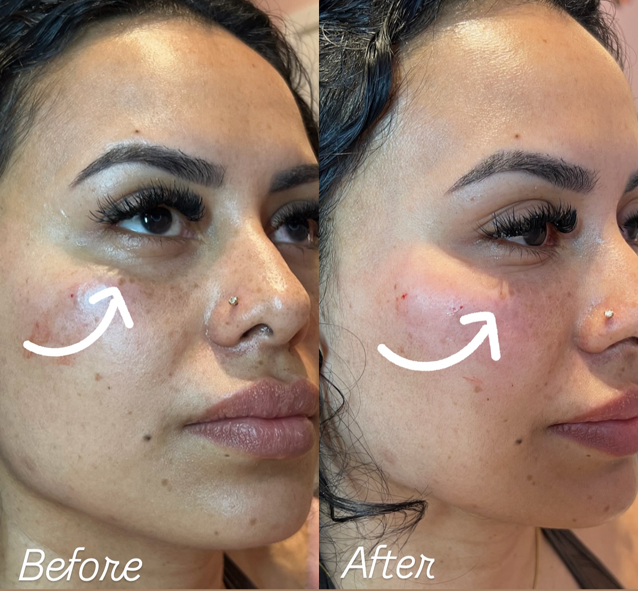 Before and after Dermal Fillers result 2