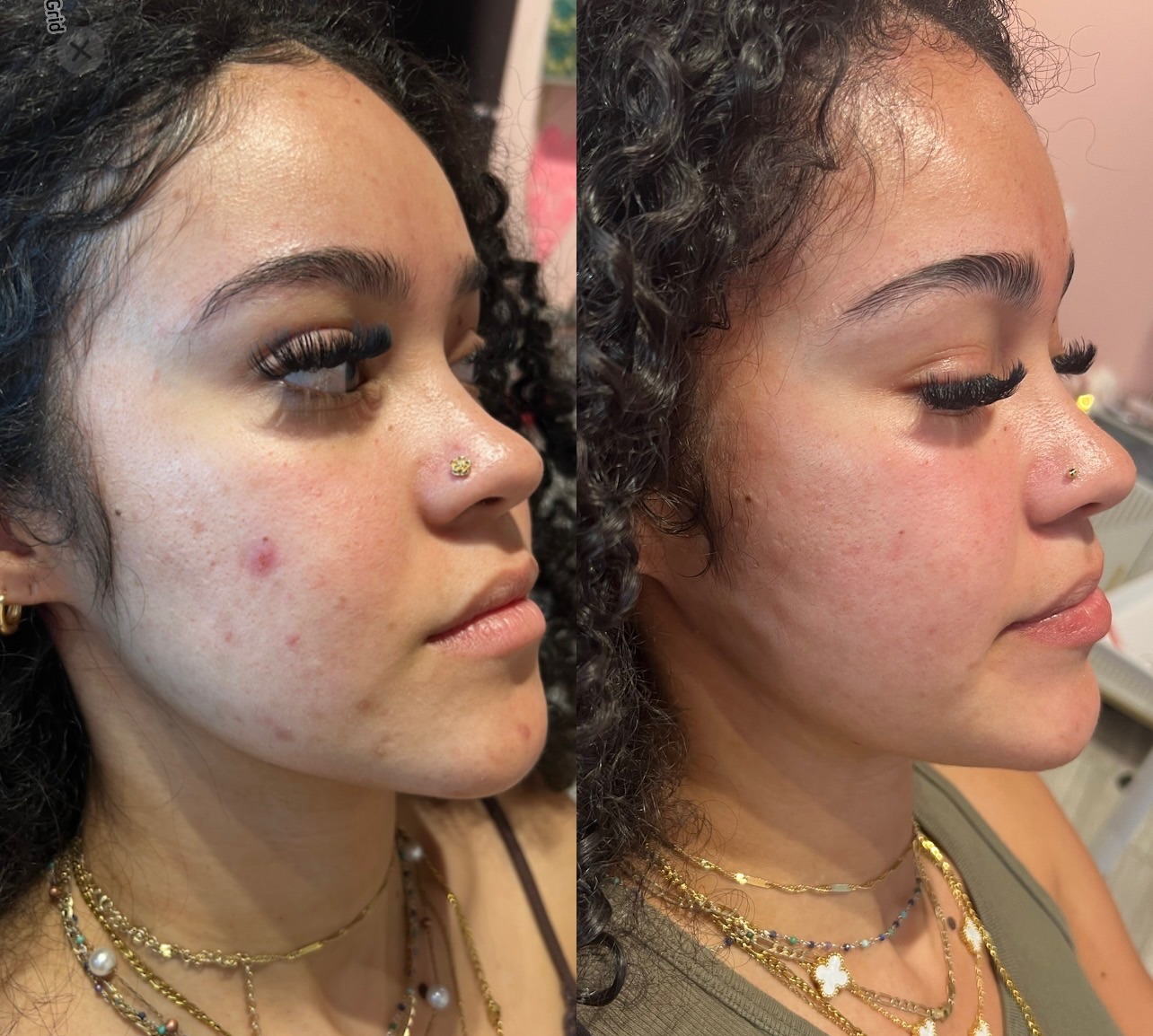 Before and after IPL result 3