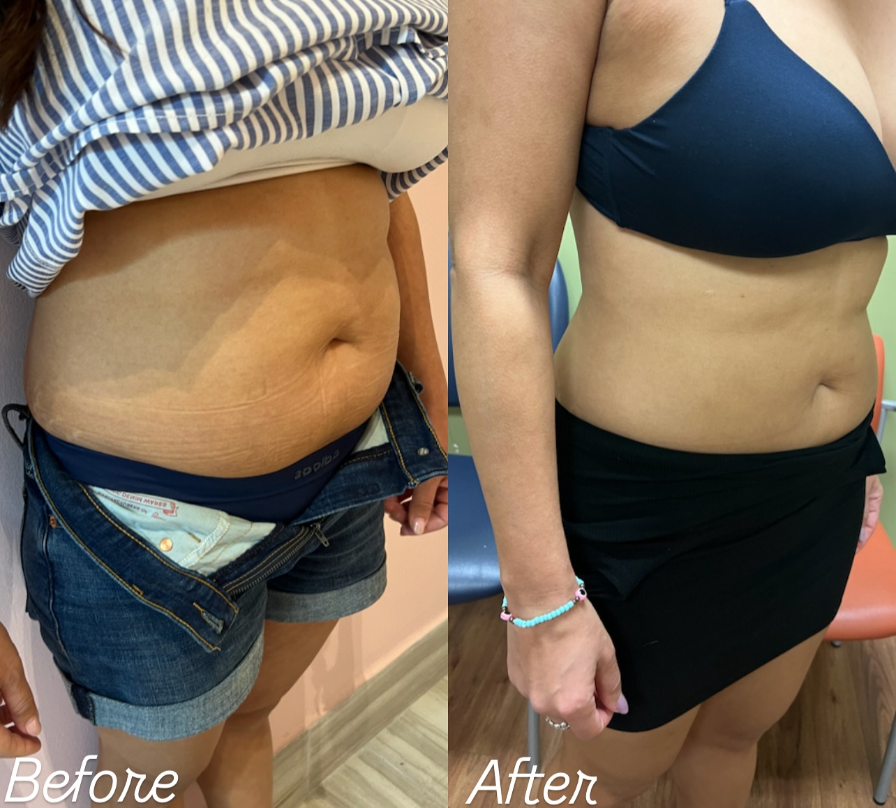 Before and after PCDC Fat Dissolving result 1