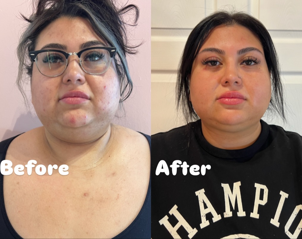 Before and after PCDC Fat Dissolving result 2