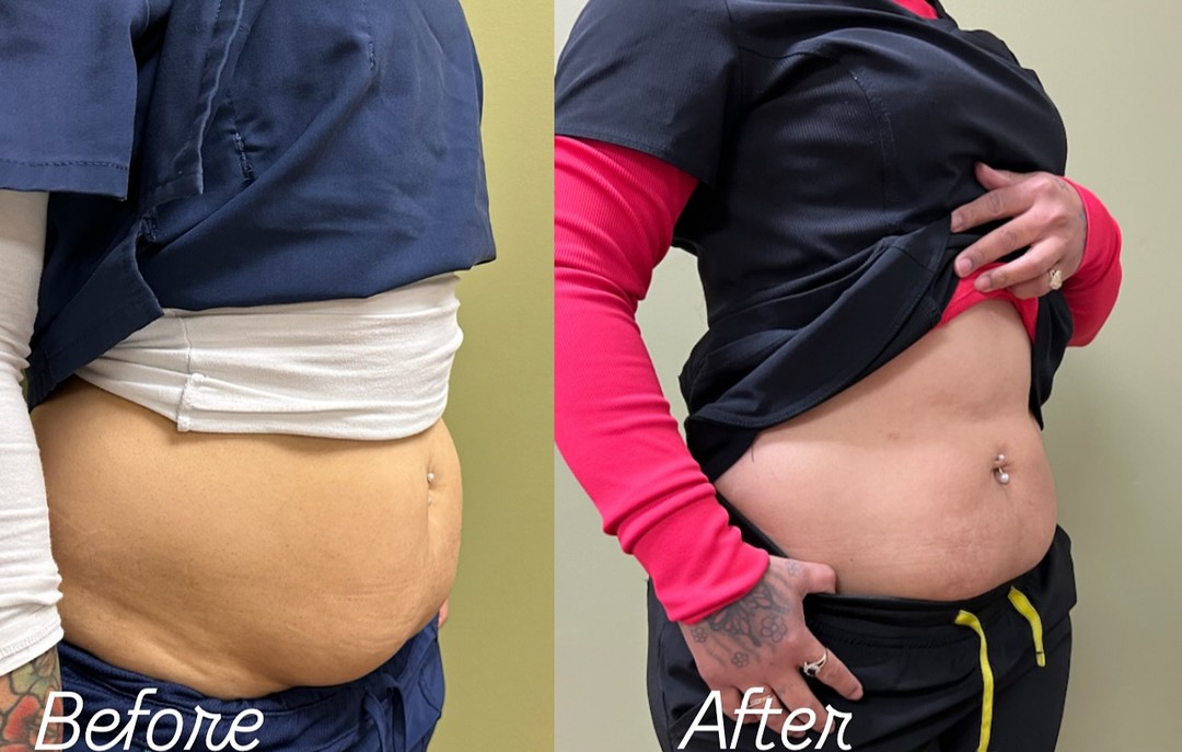 Before and after PCDC Fat Dissolving result 3