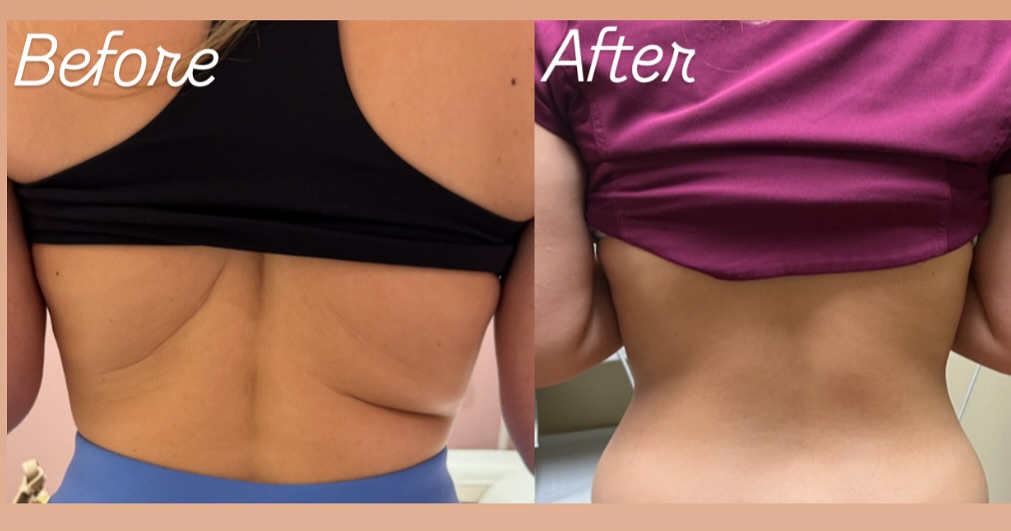 Before and after PCDC Fat Dissolving result 4