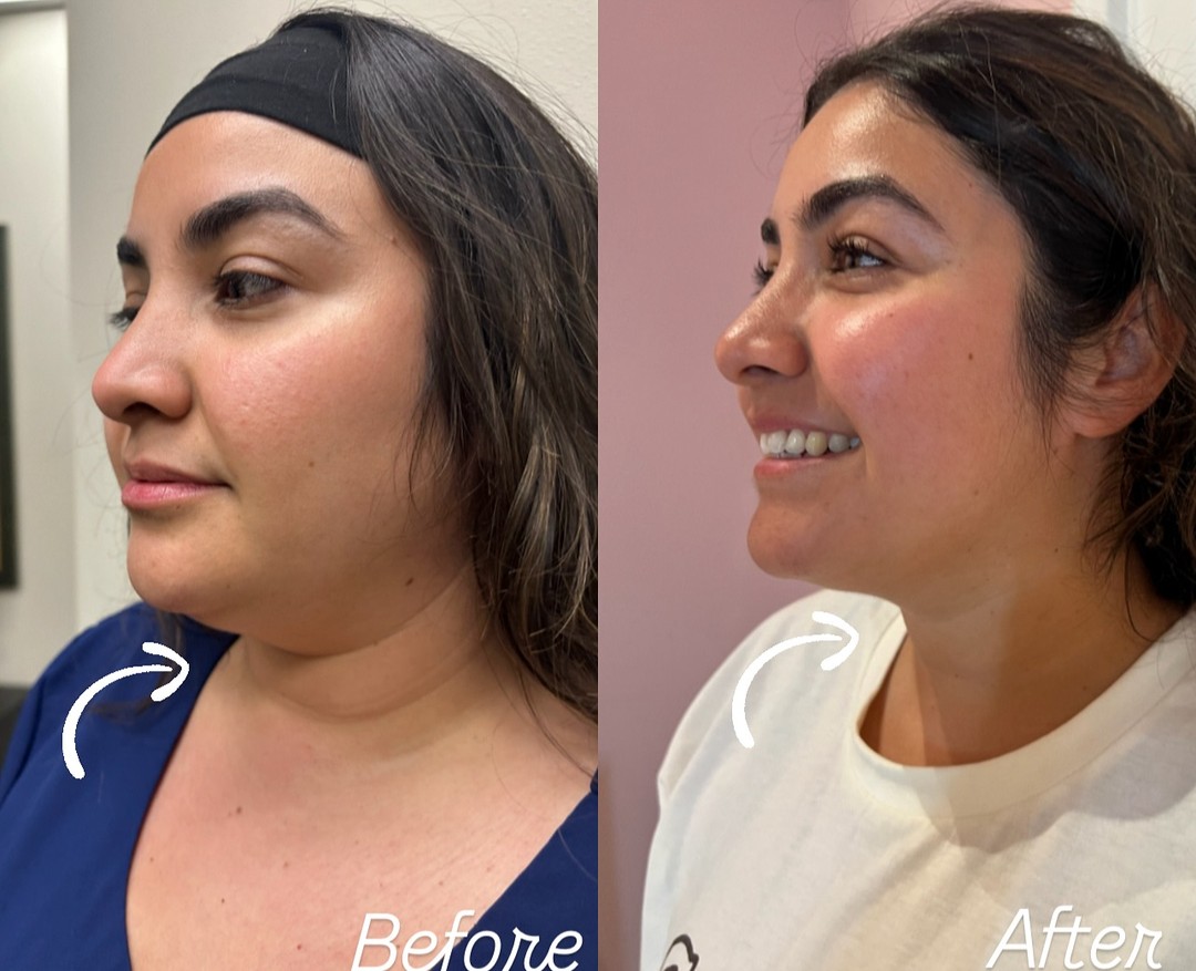 Before and after PCDC Fat Dissolving result 5