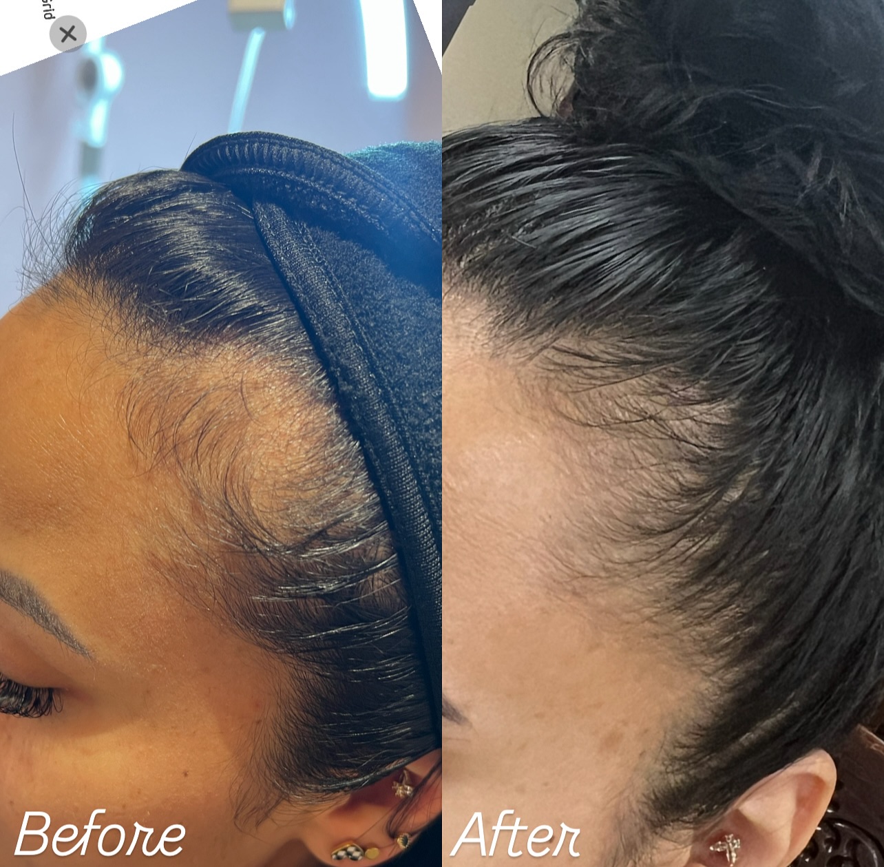 Before and after PRP Hair Restoration result 1