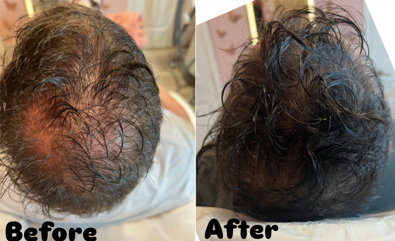 Before and after PRP Hair Restoration result 3