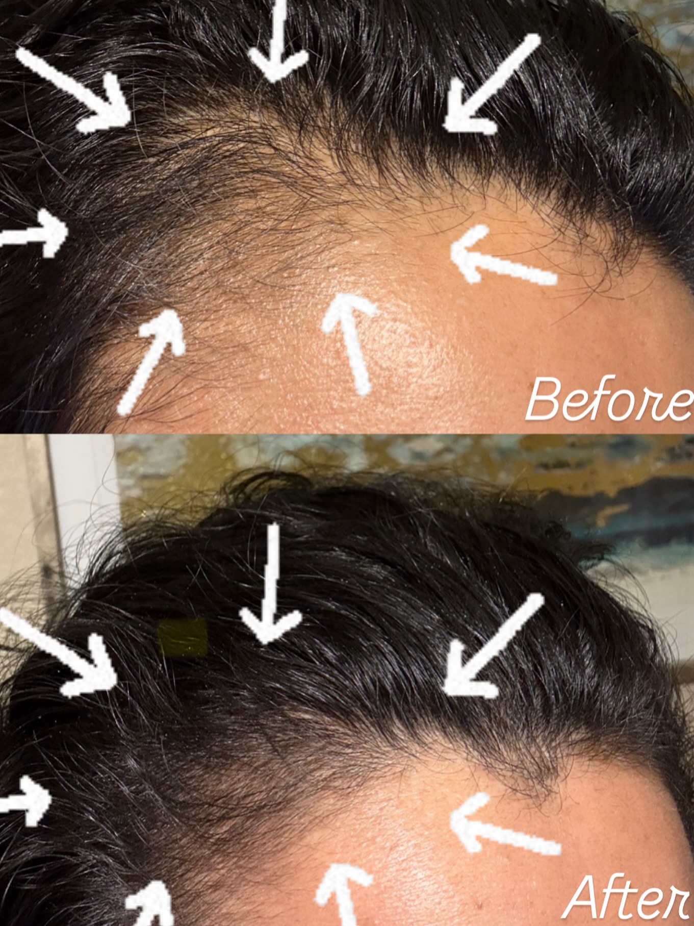 Before and after PRP Hair Restoration result 4