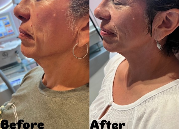 Before and after Skin Rejuvenation result 1