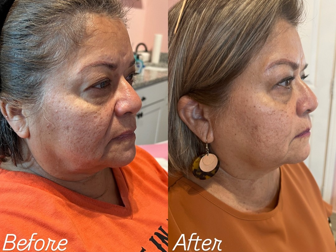Before and after Skin Rejuvenation result 2