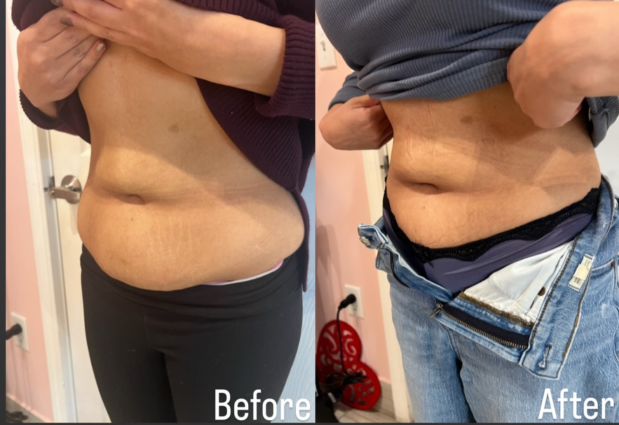 Before and after Skin Rejuvenation result 3